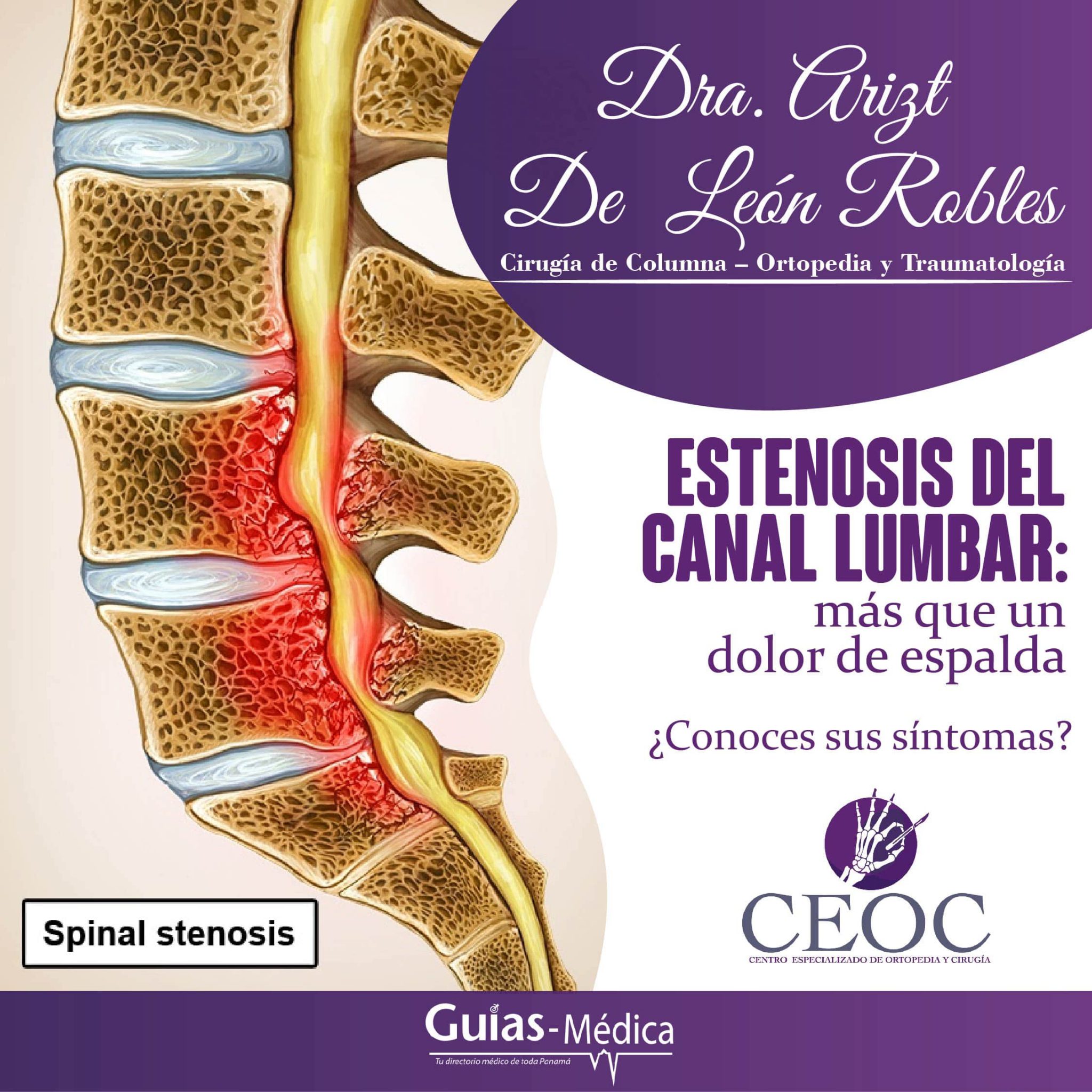 Estenosis Del Canal Lumbar Más Que Un Dolor De Espalda Guía Médica 3791
